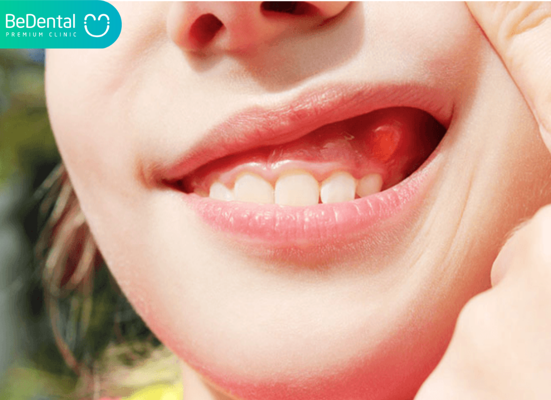 Broken Wisdom Teeth in Vietnam. Broken Wisdom Teeth in Vietnam. Broken Wisdom Teeth in Vietnam