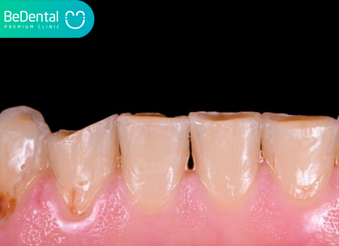 Sâu răng để lâu có sao không?