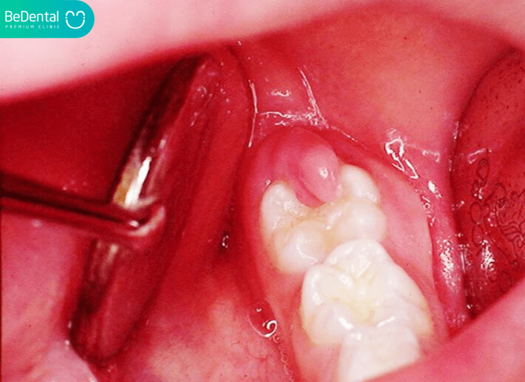 Lưu ý sau khi nhổ răng khôn