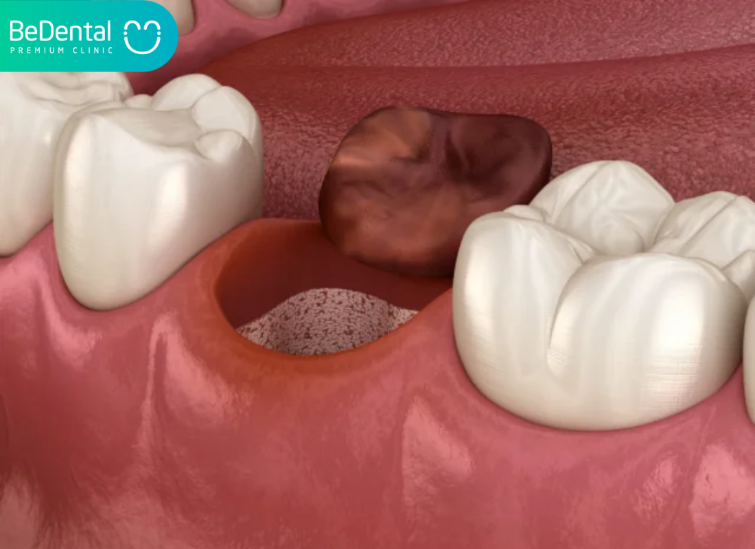 Decayed Wisdom Teeth in Vietnam and What You Need to Know 4 Decayed Wisdom Teeth in Vietnam. Decayed Wisdom Teeth in Vietnam. Decayed Wisdom Teeth in Vietnam