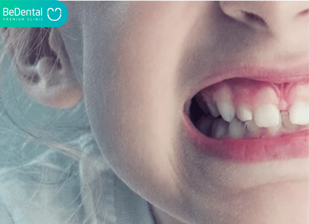 Trẻ nghiến răng thiếu chất gì