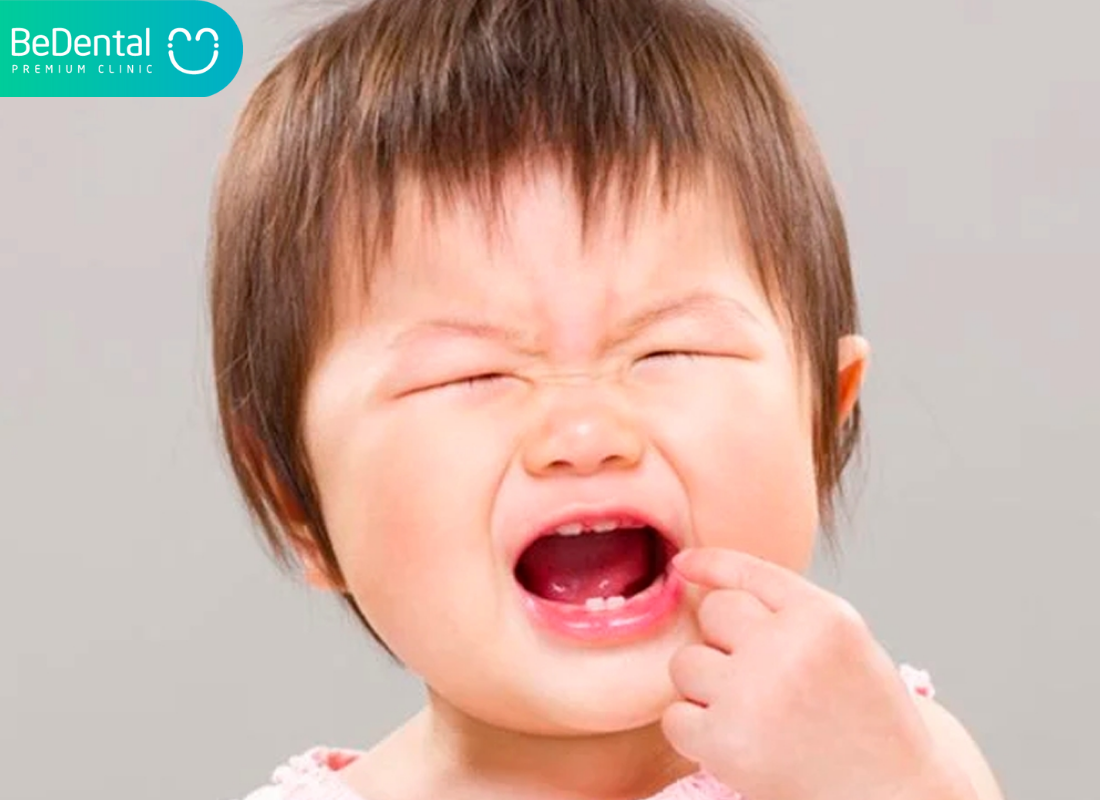 Trường hợp nanh sữa lành tính