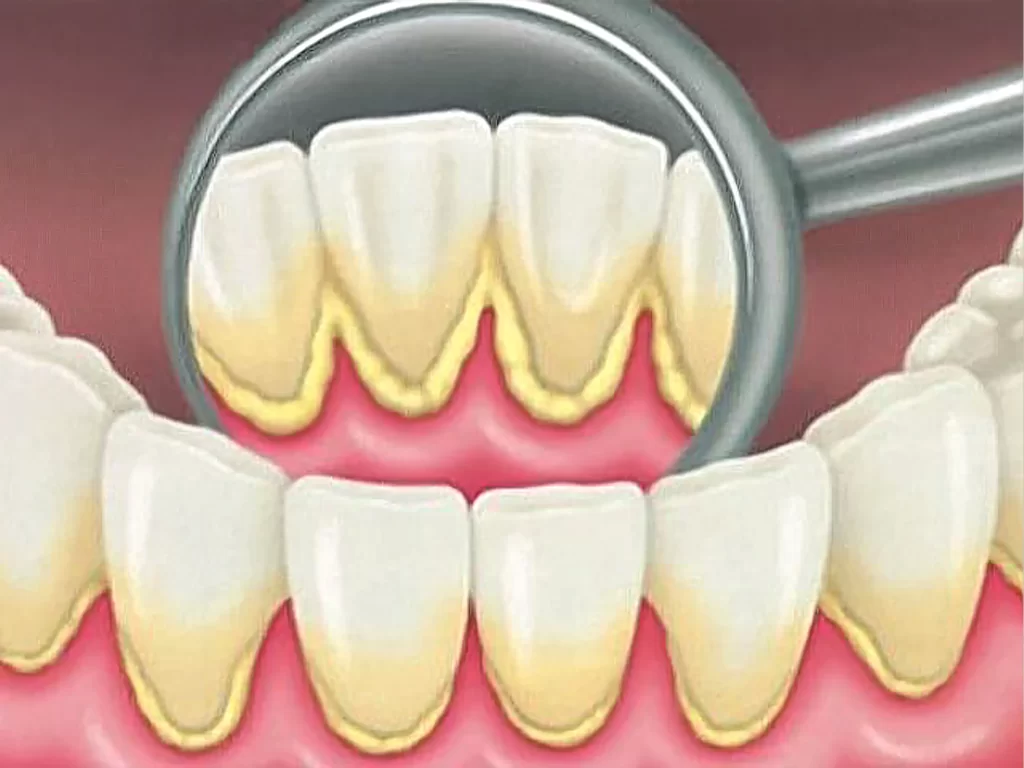 lấy cao răng có làm trắng răng không
