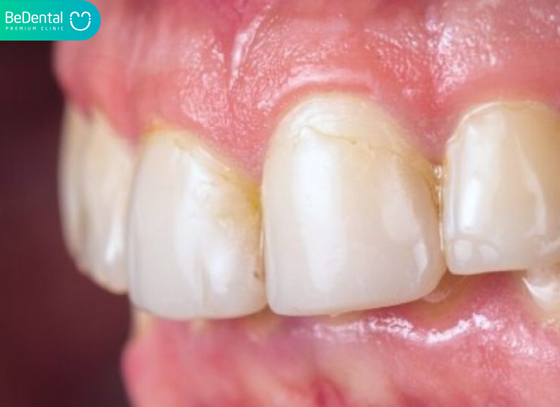 lợi chân răng bị trắng