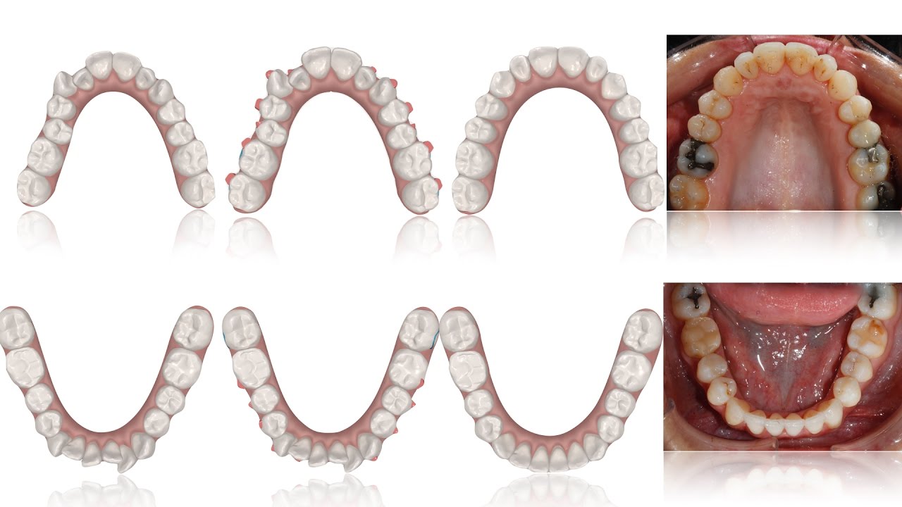 Gắn Attachment trong niềng răng Invisalign