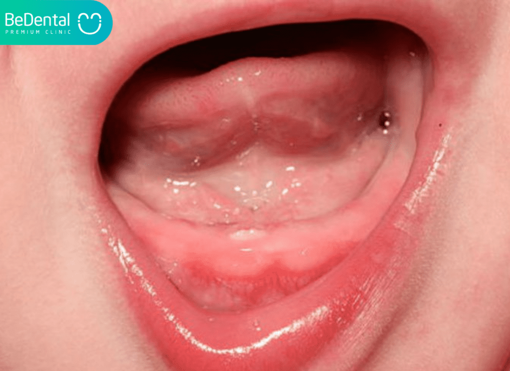 nanh sua va rang bam sinh