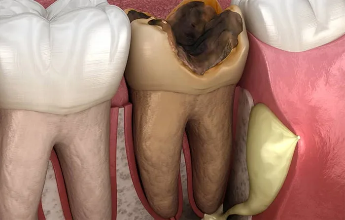 Áp xe quanh chóp răng là gì?