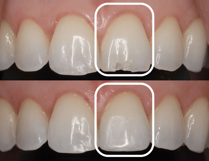 rang cua me nho co the ap dung phuong phap tram composite