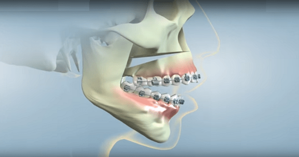 Orthodontics in Vietnam. Orthodontics in Vietnam. Orthodontics in Vietnam