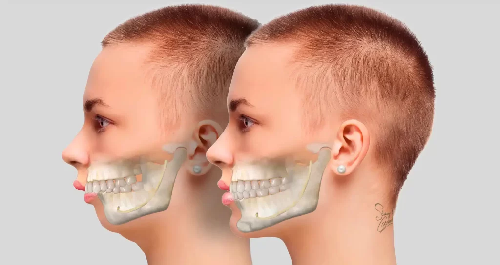 Hàm hô là gì và các phương pháp điều trị hiệu quả 2 Hàm hô là gì