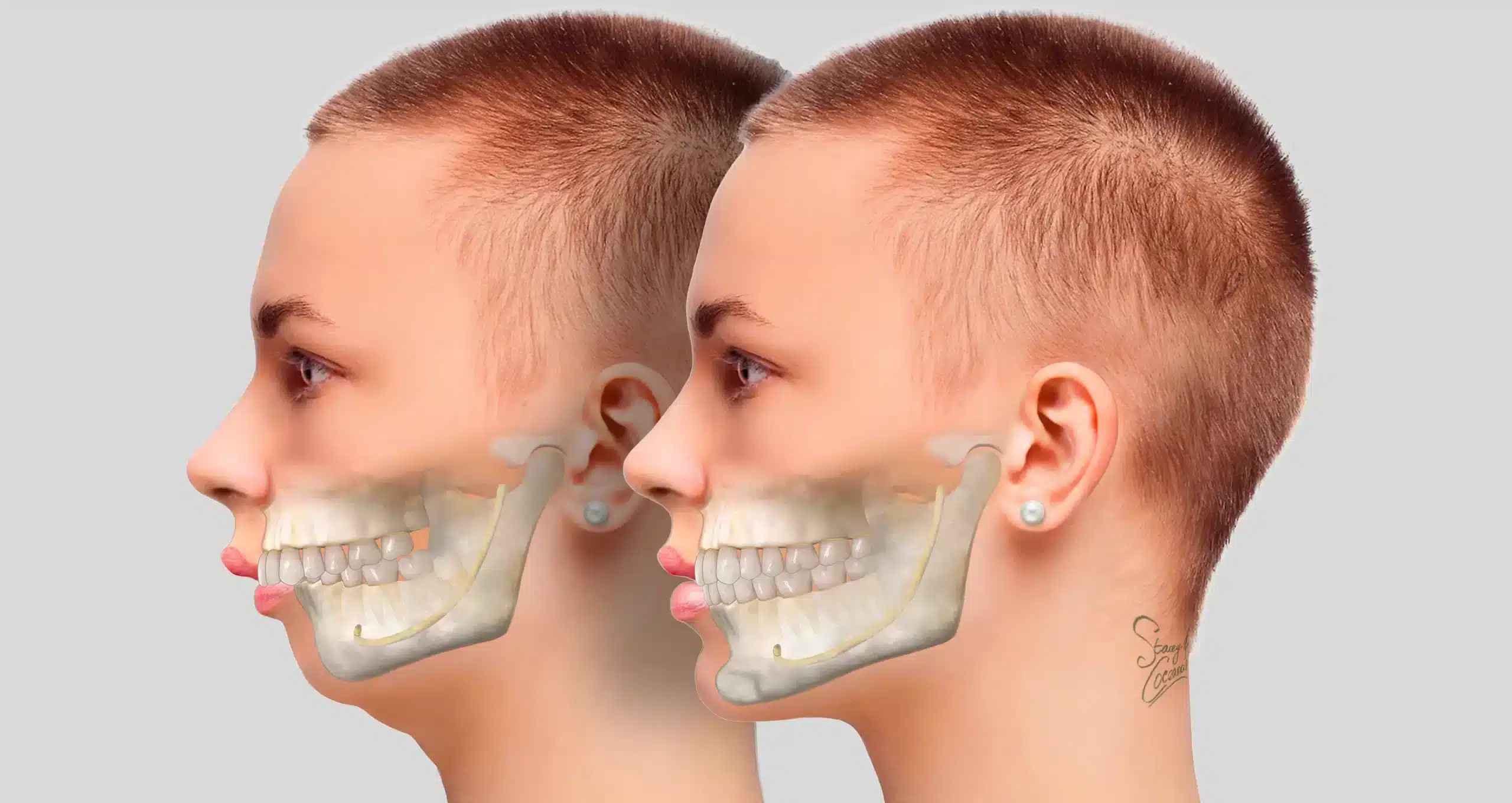 Phẫu thuật hàm hô có nguy hiểm không?