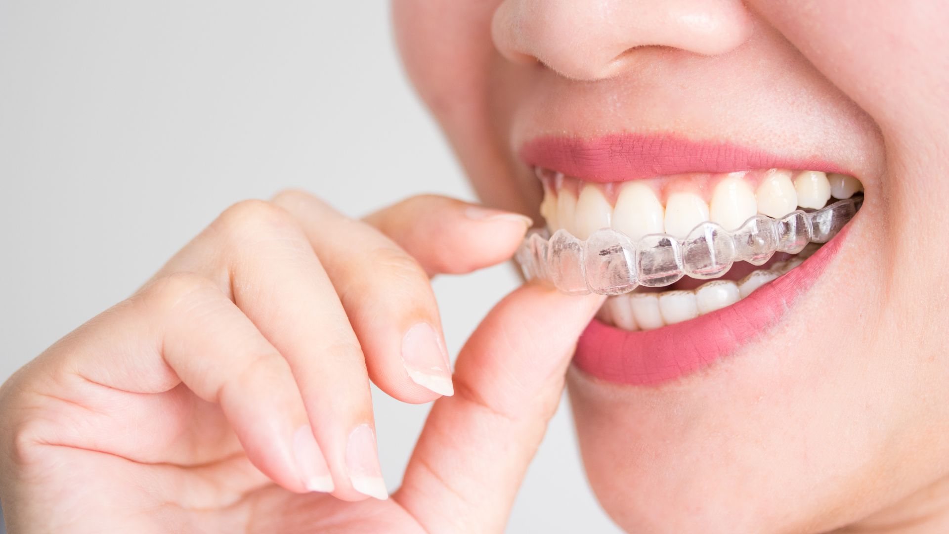 Removable Braces in Vietnam. Removable Braces in Vietnam. Removable Braces in Vietnam