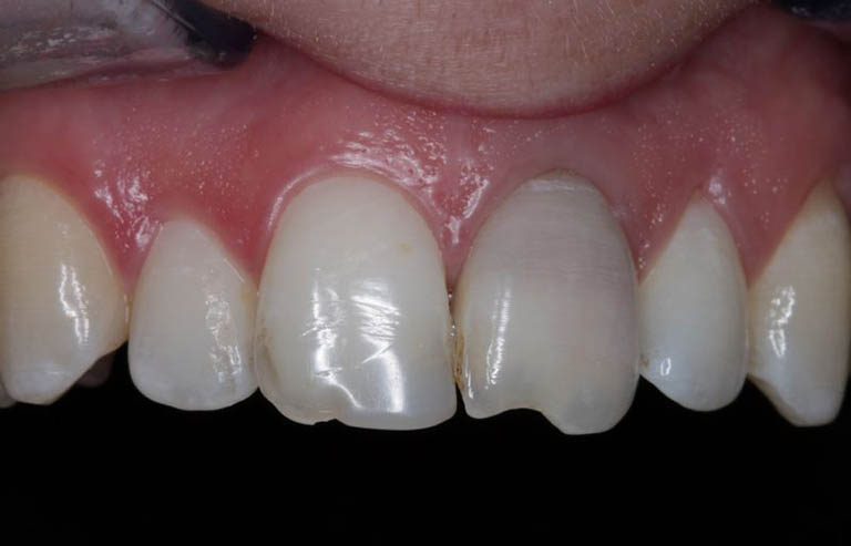 Răng mẻ có phải là điềm không lành?