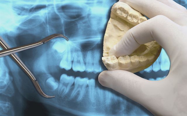 Răng khôn mọc lệch ra má hàm trên nguy hiểm thế nào và nên làm gì? 4 Răng khôn mọc lệch ra má hàm trên. Răng khôn mọc lệch ra má hàm trên. Răng khôn mọc lệch ra má hàm trên