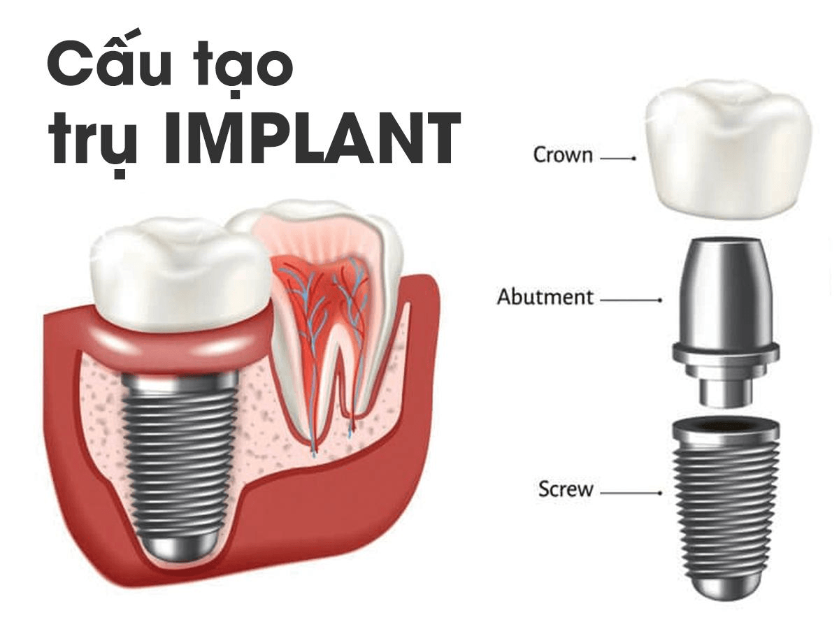 Cấu tạo Implant