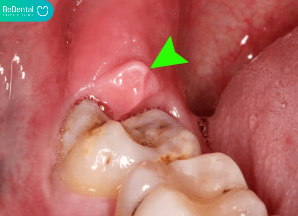 viem loi trum rang khon