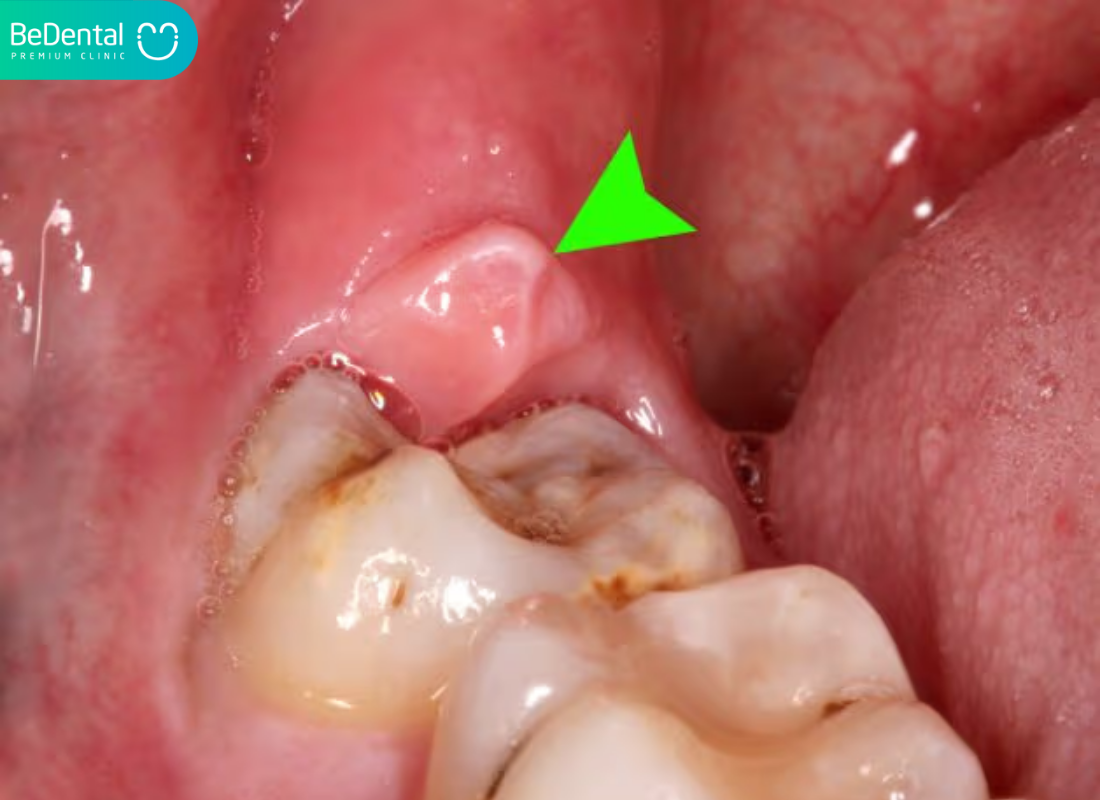 tại sao phải nhổ răng khôn