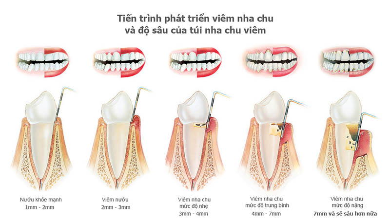 Viêm nha chu nhẹ là gì?