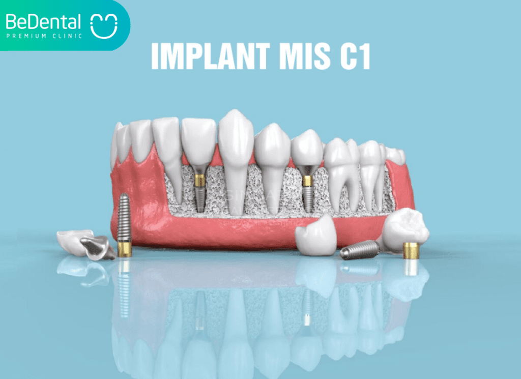 Implant MIS C1