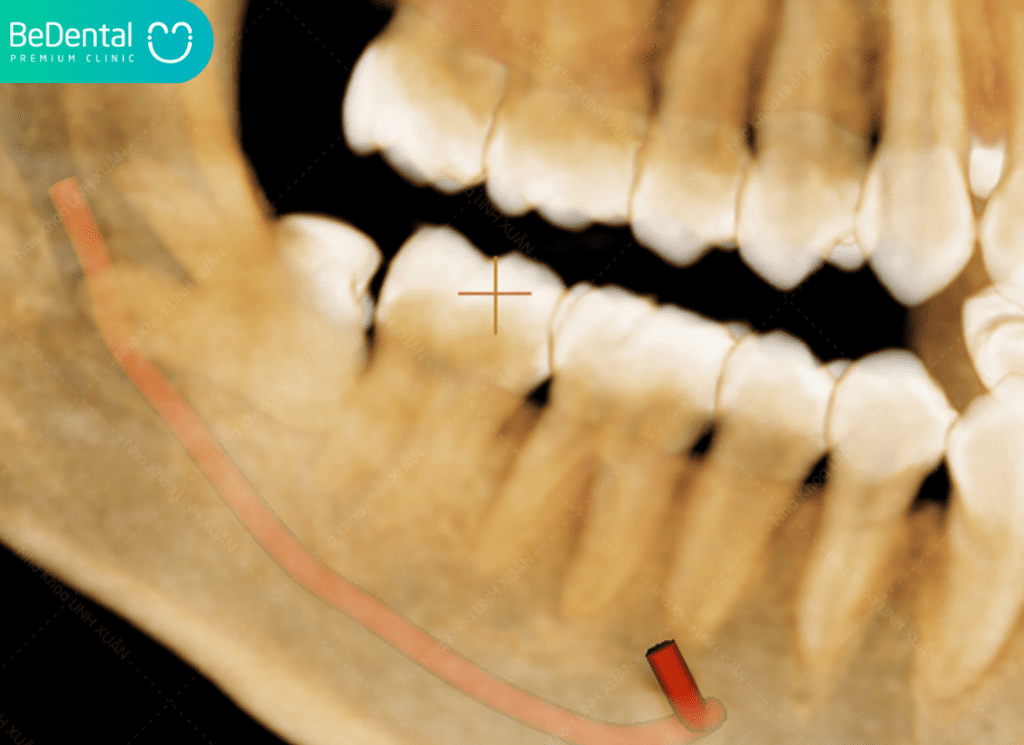 Răng khôn chèn dây thần kinh