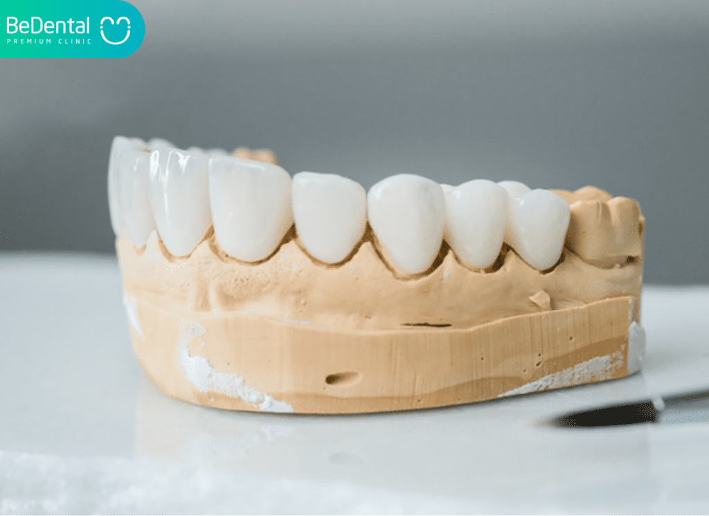 Roland Dental crowns in Vietnam