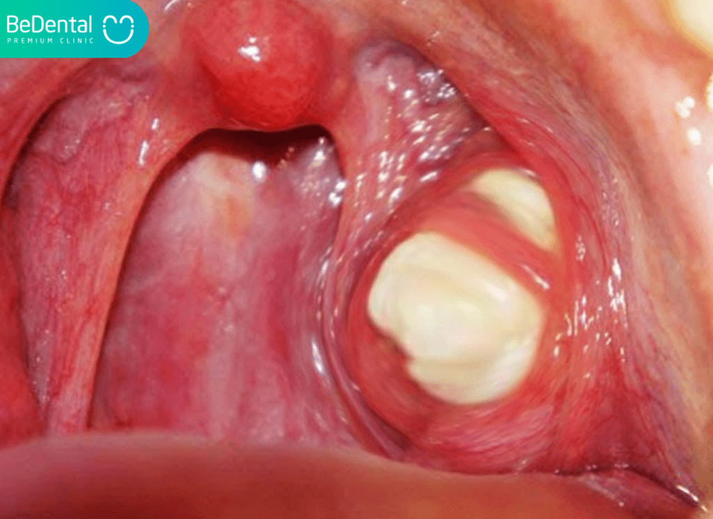 Viem amidan hoc mu va soi amidan