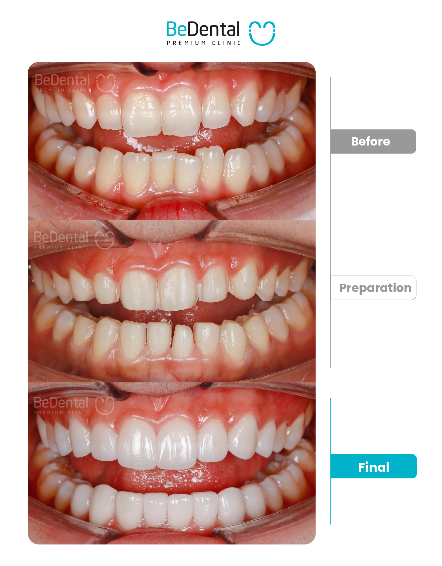 Kết quả bọc răng sứ