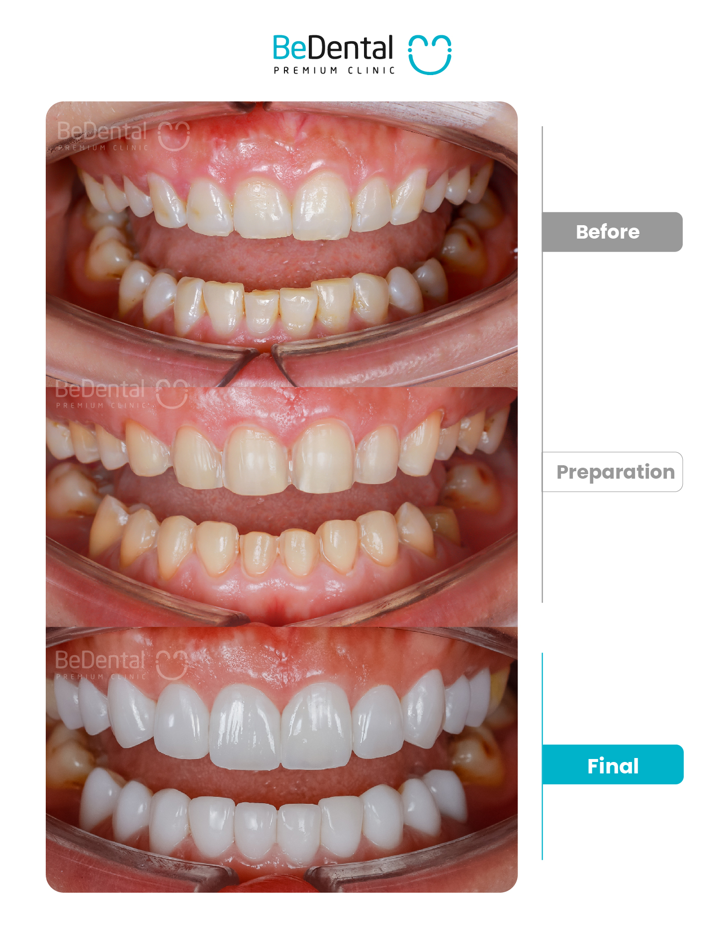 Kết quả dán sứ Veneer