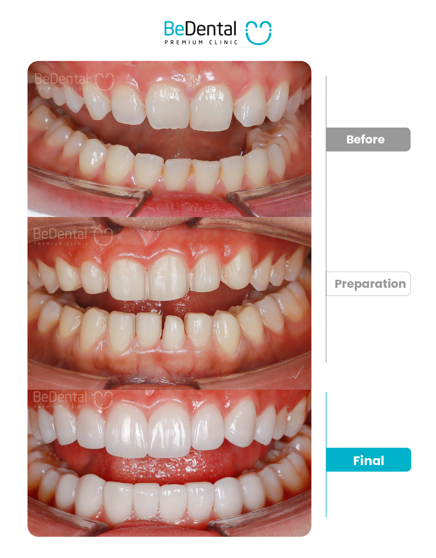 Kết quả bọc răng sứ