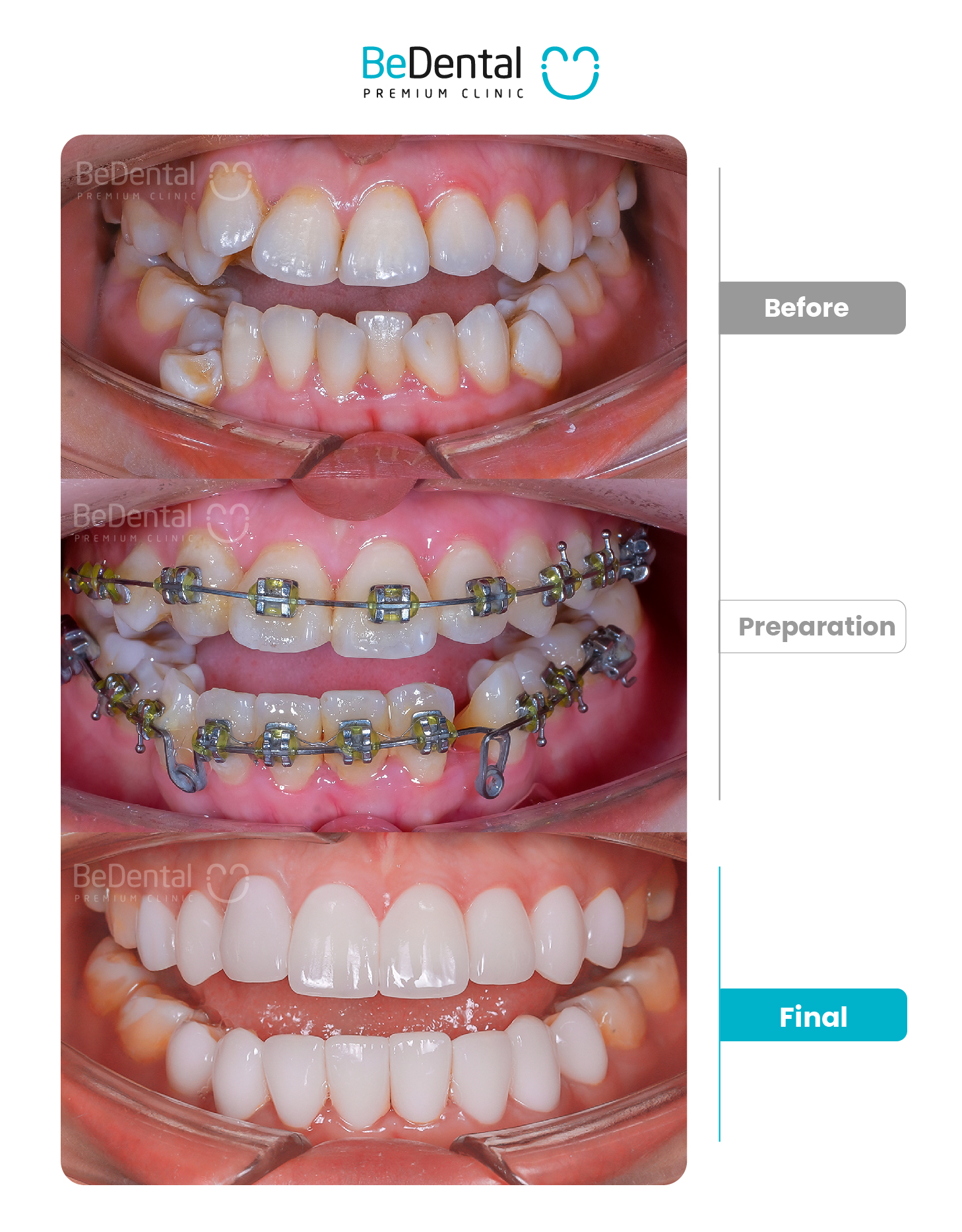 Kết quả dán sứ Veneer