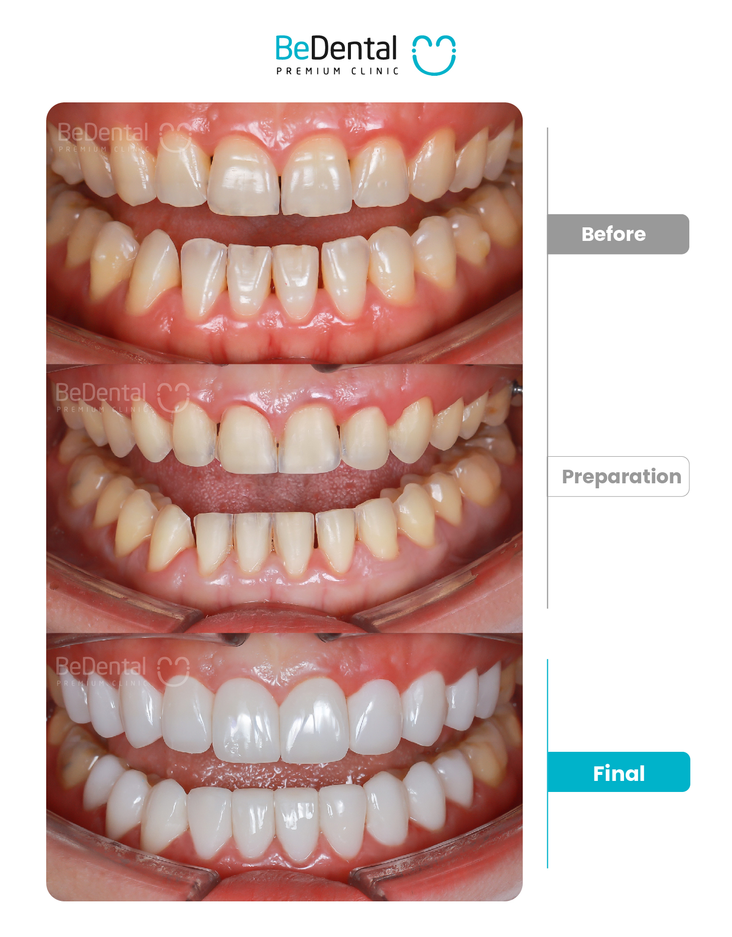 Kết quả bọc sứ