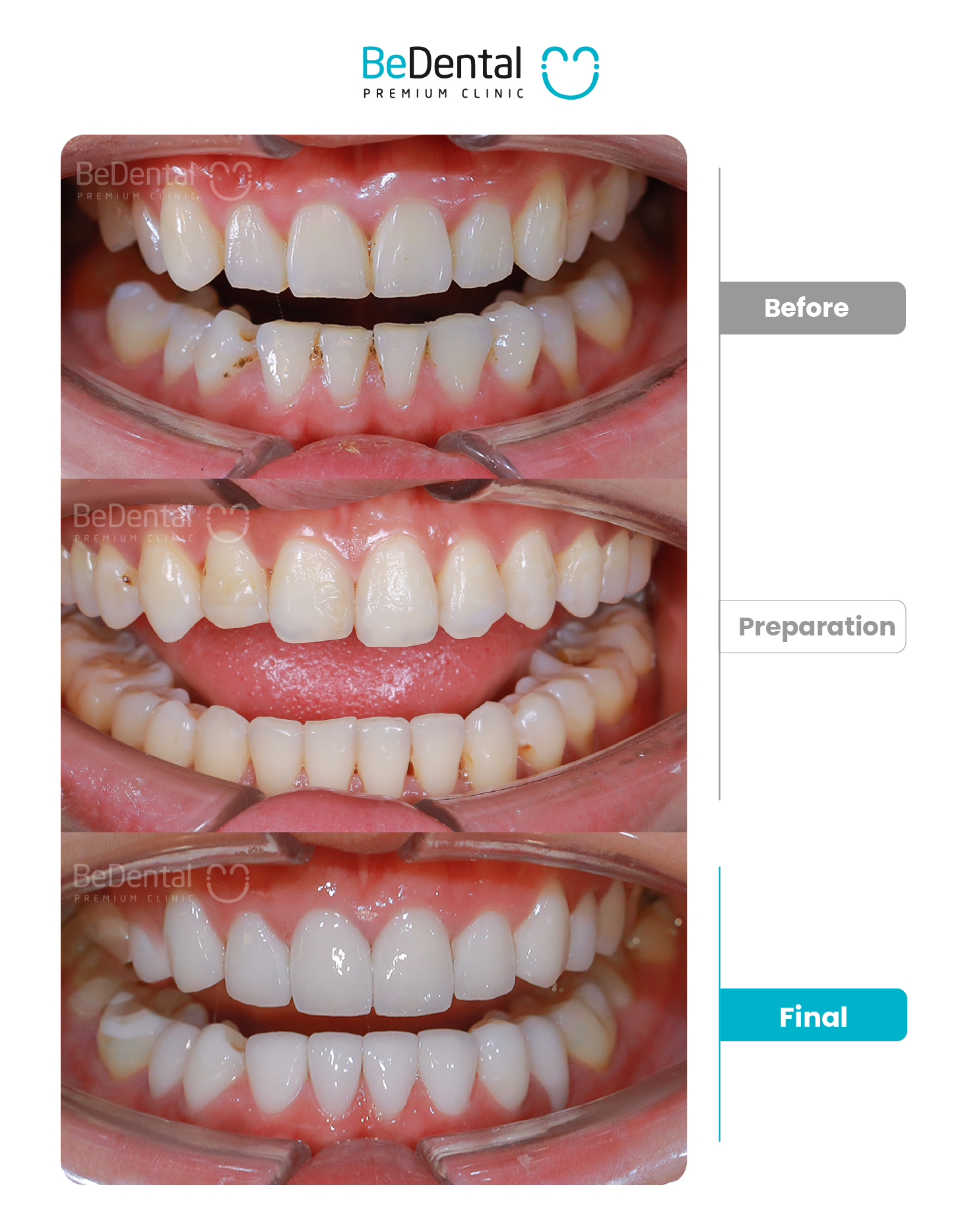 Kết quả bọc răng sứ