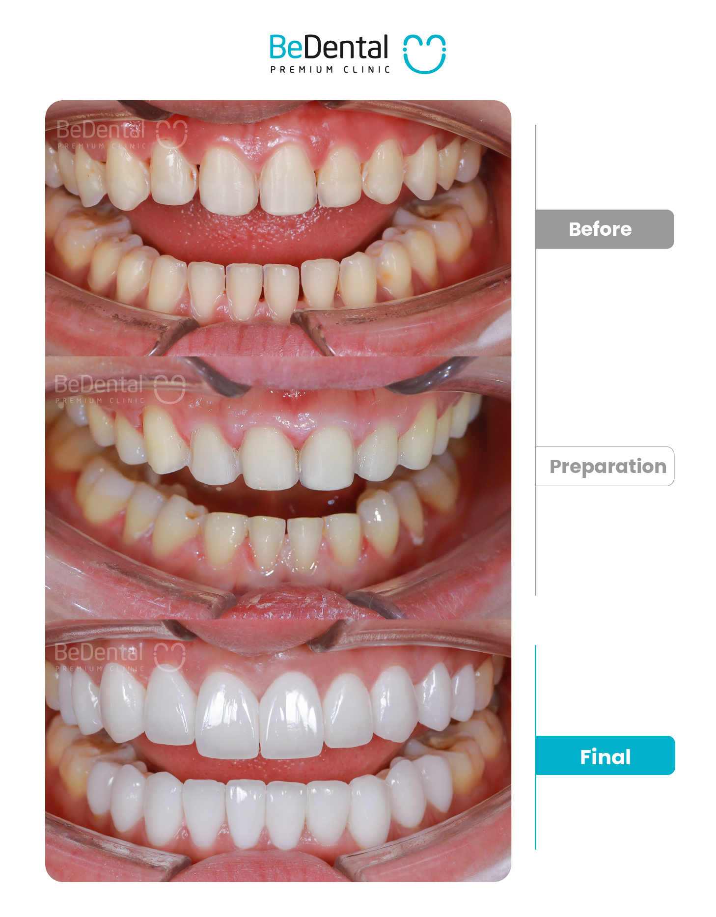 Kết quả dán sứ Veneer