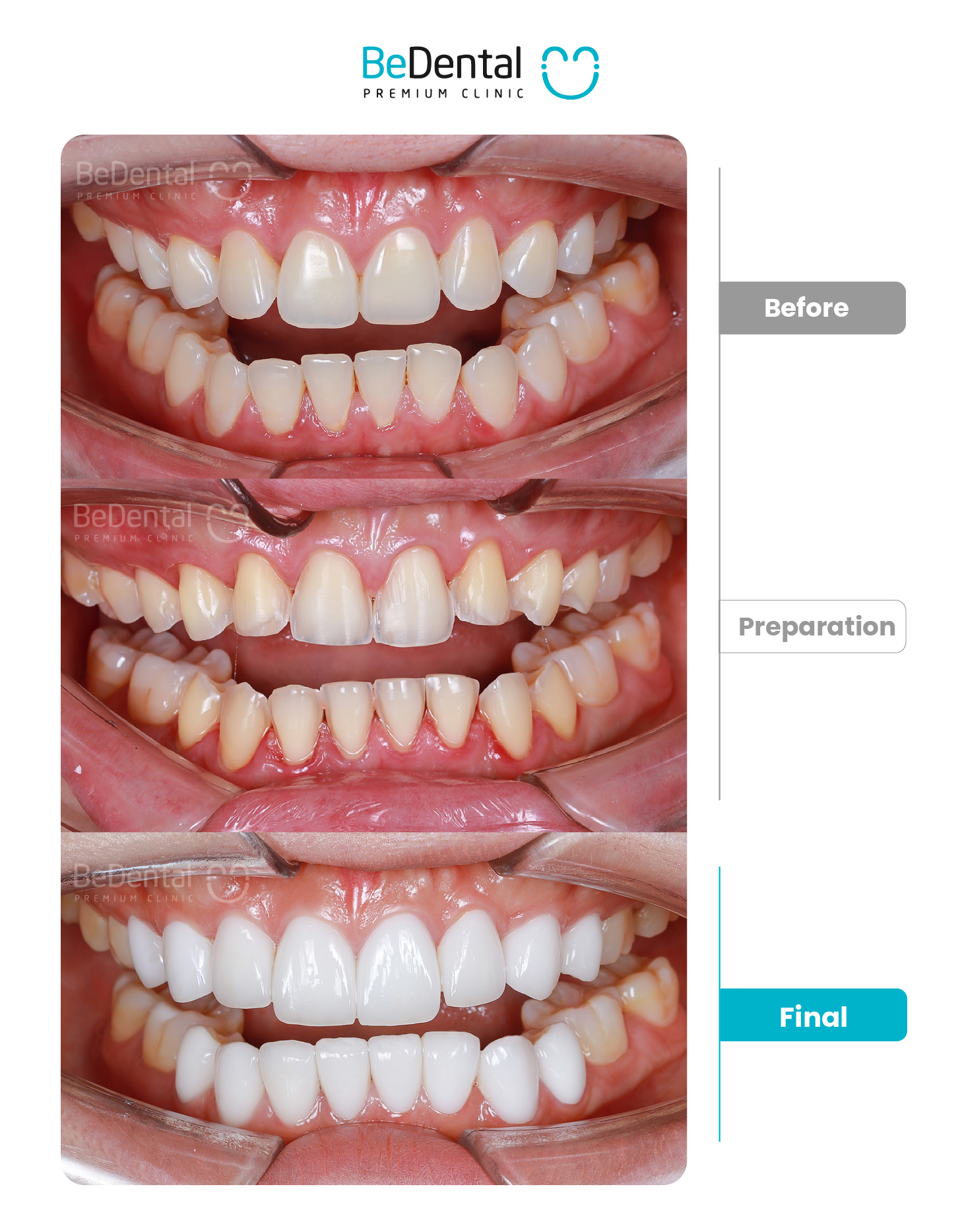 Kết quả bọc sứ