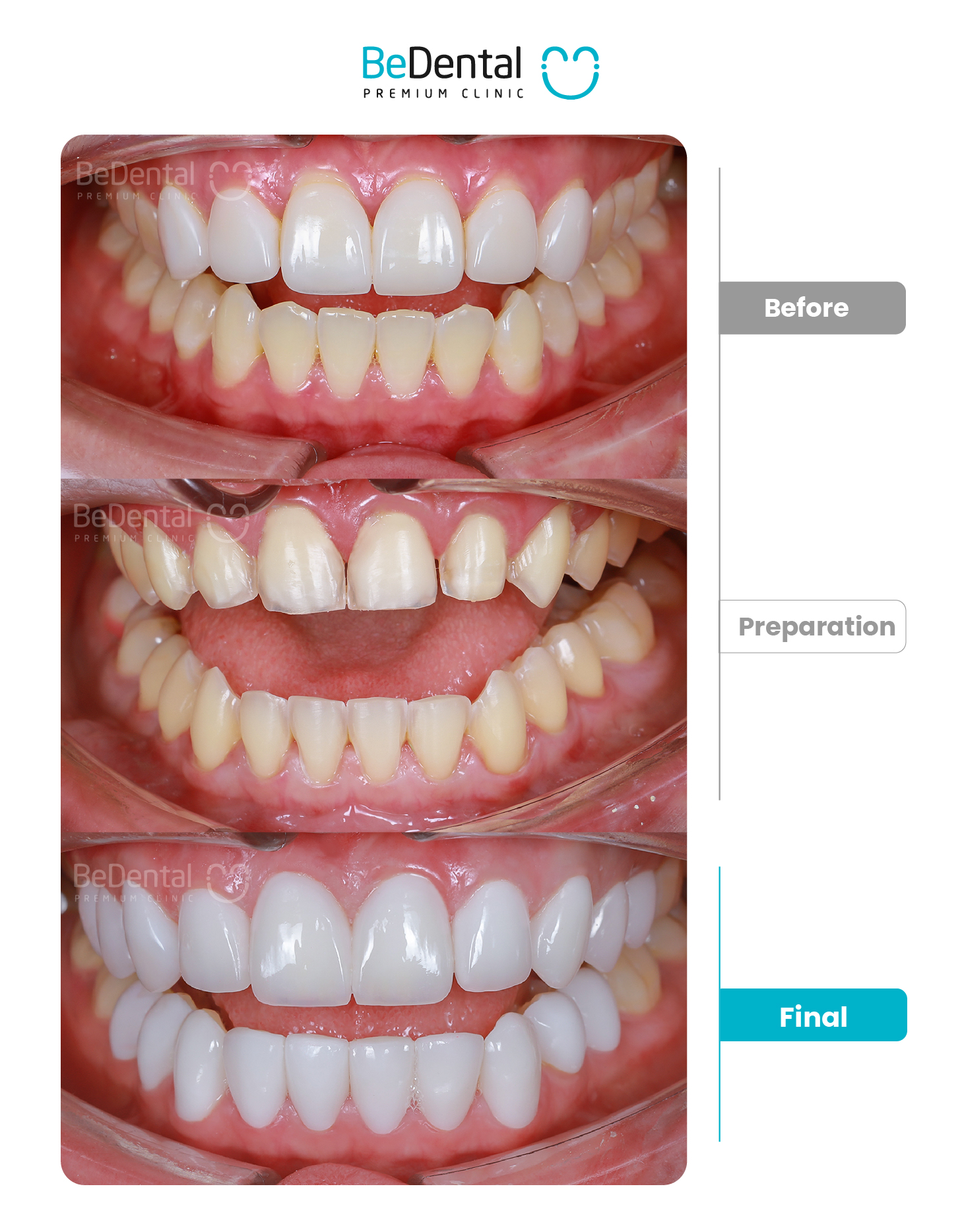 Kết quả dán sứ