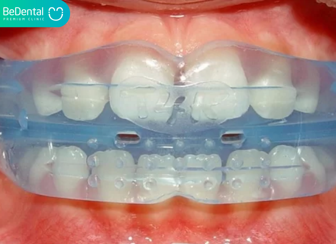 Hàm niềng răng silicon