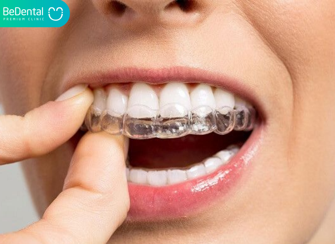 nắn chỉnh 2 răng cửa