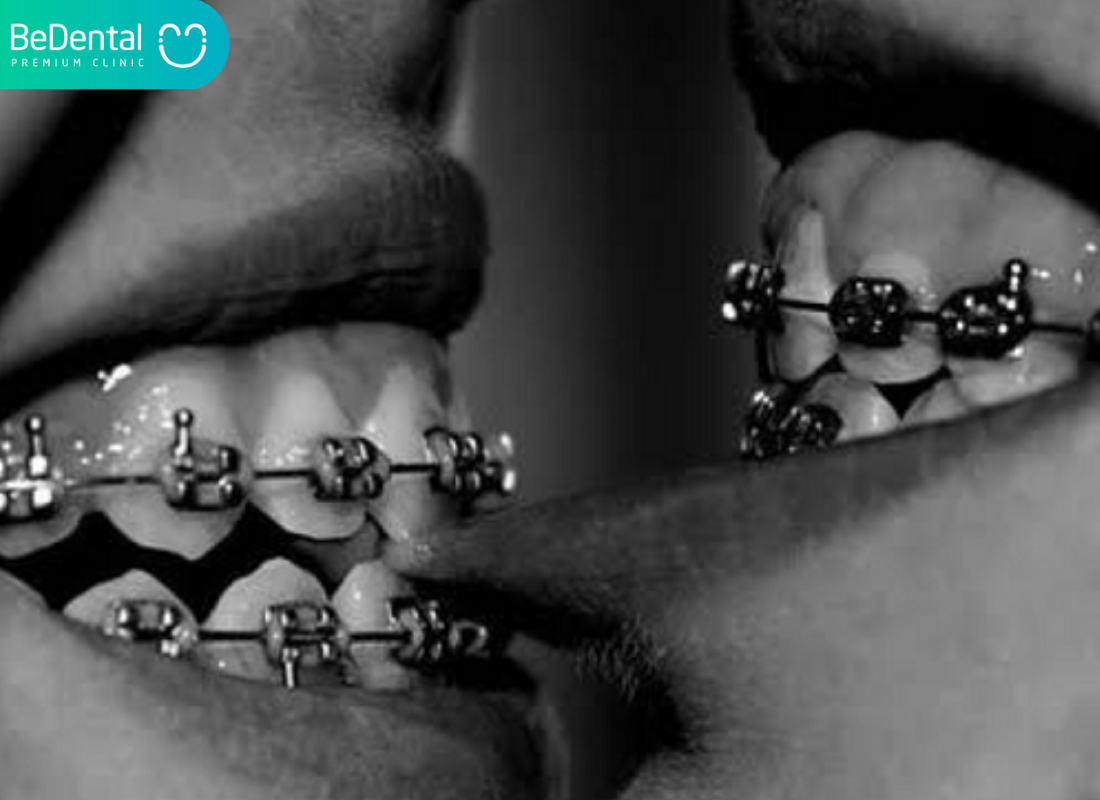 Niềng răng có hôn được không