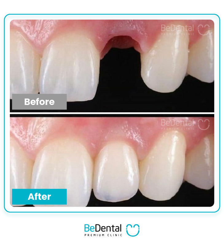 Dental Implant