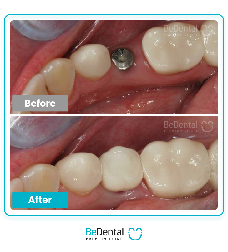 Dental Implant