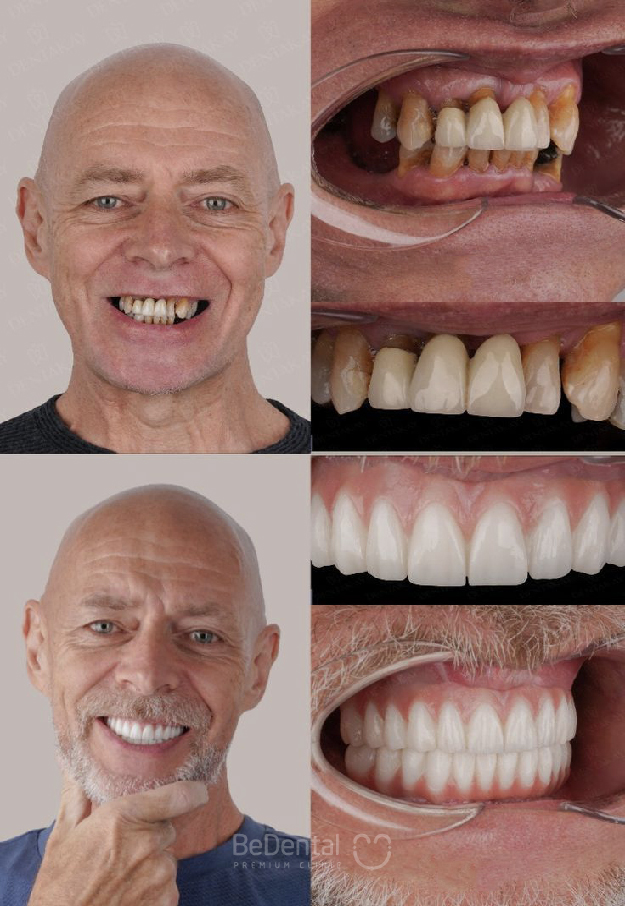 Full Arch Implant