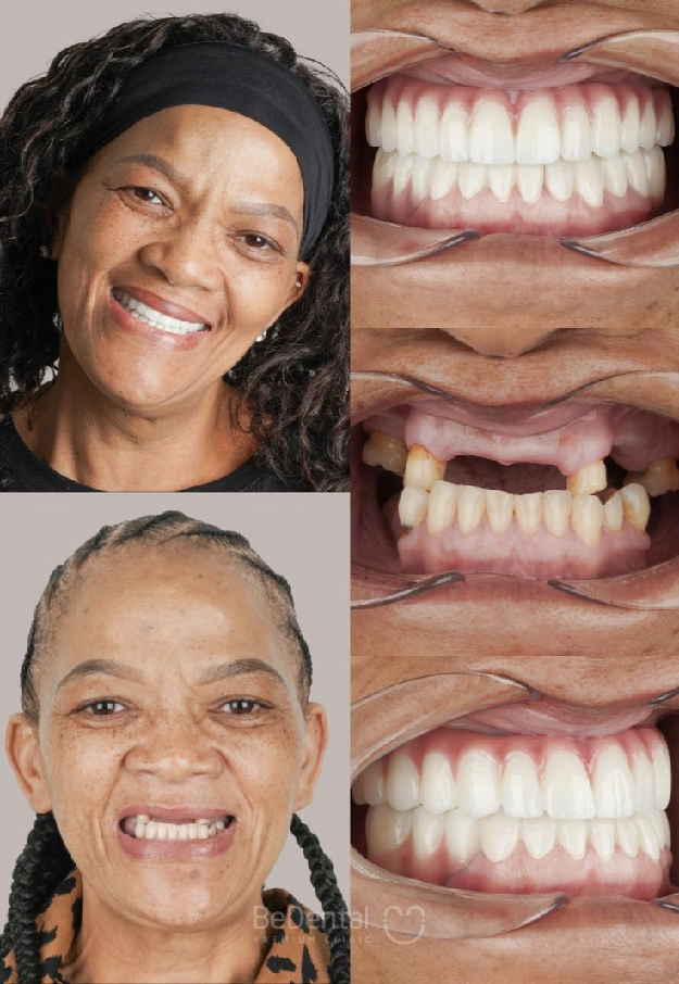Full Arch Implant