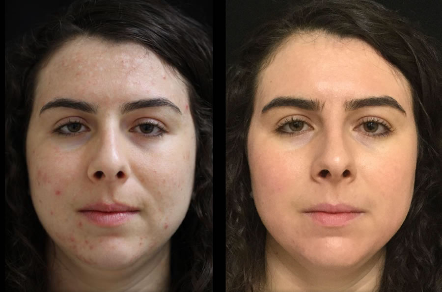 Acne Scar Treatment in Vietnam: Restore Smooth and Even Skin Texture 5 Acne Scar Treatment in Vietnam 3