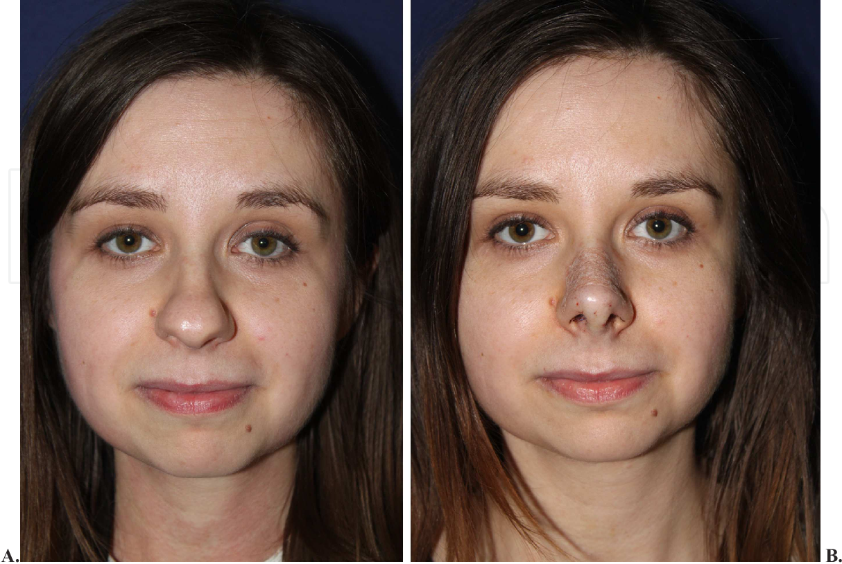 Alar Base Reduction in Vietnam: Refine Your Nose Shape with Precision 3 Alar Base Reduction in Vietnam: Refine Your Nose Shape with Precision