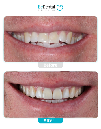 Cracked Tooth in Vietnam. Cracked Tooth in Vietnam. Cracked Tooth in Vietnam. Cracked Tooth in Vietnam