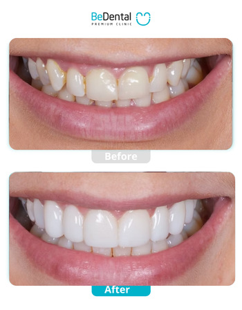 Beautiful Porcelain Definition in Vietnam: What Makes a Truly Beautiful Dental Crown? 3 Beautiful Porcelain Definition in Vietnam