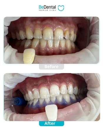 Benefits of Cosmetic Porcelain Crowns in Vietnam 3 BA web.pdf