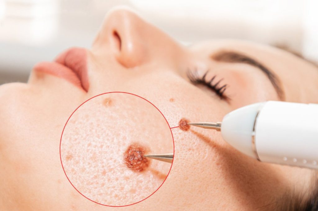 Birthmark Removal in Vietnam 1