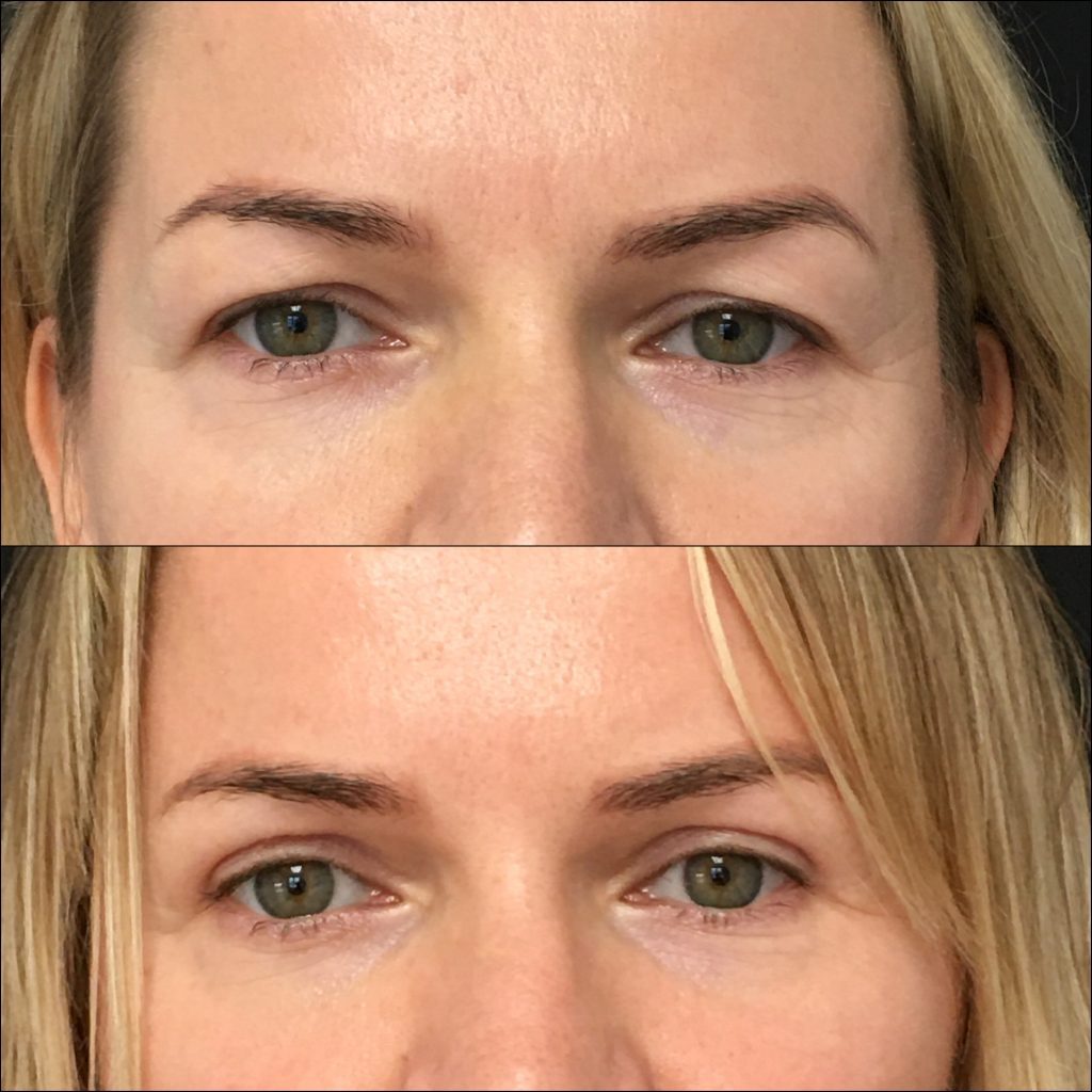 Blepharoplasty in Vietnam 1
