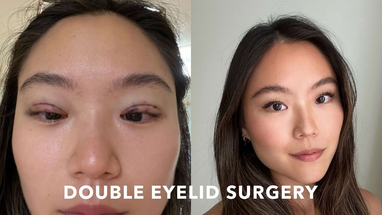Blepharoplasty in Vietnam: Rejuvenate Your Eyes with Precision Surgery 4 Blepharoplasty in Vietnam 2